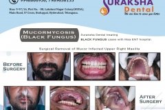 black-fungus-treatment-1