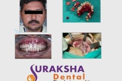 black-fungus-treatment-3